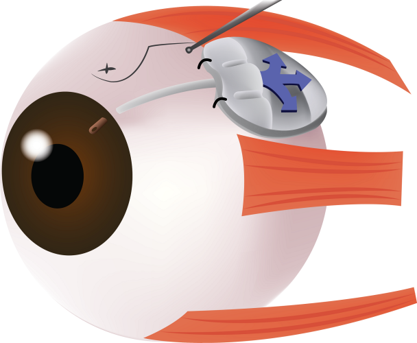 glaucoma